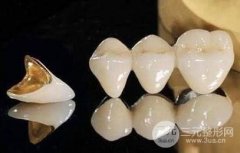 镍铬合金烤瓷牙能维持的时间以及优缺点大揭秘