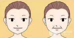 有法令纹怎么办？附P埋埋提升案例果对比图分享~