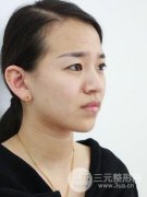 祛除抬头纹多少钱？注射瘦脸除皱案例果前后对比图片分享~