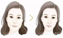 咬肌切除手术成好吗、有风险吗