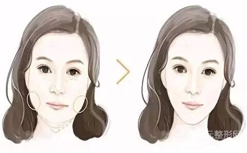 咬肌切除手术成好吗、有风险吗