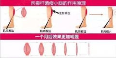 注射瘦腿一针多少钱？果能管多久？需要注射几次？
