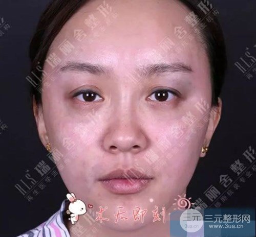 脸颊凹陷部位做完脂肪填充果