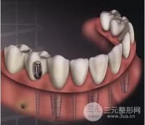 奥齿泰种植牙果怎么样？亲诉牙齿种植的过程感受分享~