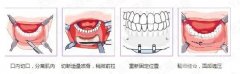 假体垫下巴手术过程、材料选择和术后注意事项，假体垫下巴多少钱？