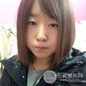 割双眼皮案例和恢复过程真人分享