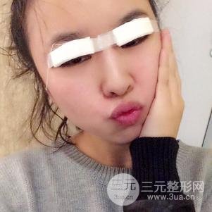 割双眼皮案例和恢复过程真人分享