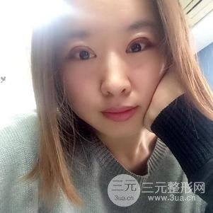 割双眼皮案例和恢复过程真人分享