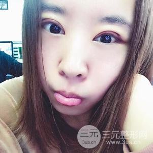 割双眼皮案例和恢复过程真人分享