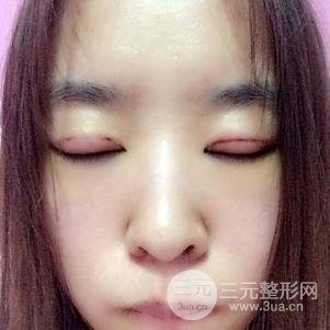 割双眼皮案例和恢复过程真人分享