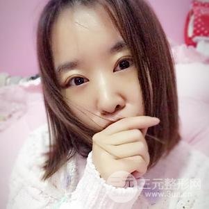 割双眼皮案例和恢复过程真人分享