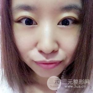 割双眼皮案例和恢复过程真人分享