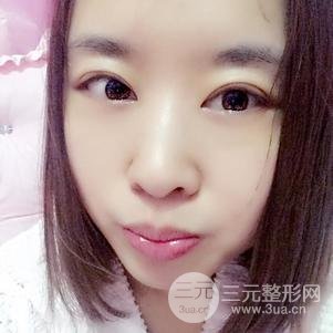 割双眼皮案例和恢复过程真人分享