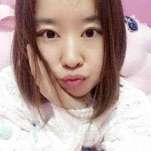 割双眼皮案例和恢复过程真人分享