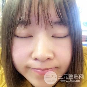 割双眼皮案例和恢复过程真人分享