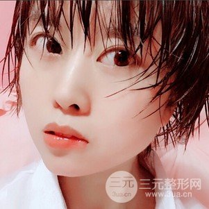 割双眼皮案例和恢复过程真人分享