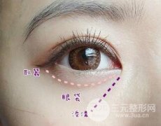 北京去眼袋手术多少钱？祛眼袋手术有哪些？应该怎样选择？