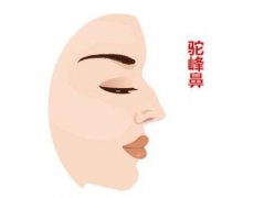 成都驼峰鼻矫正费用,驼峰鼻矫正多少钱,价格是多少 成都驼峰鼻矫正费用,驼峰鼻矫正多少钱,价格是多少
