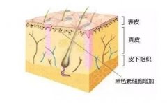 真.皮斑能用激光去掉吗？缓解真.皮斑喜欢的方法