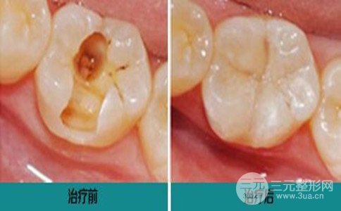 上海补牙多少钱一颗、补牙方式有哪些