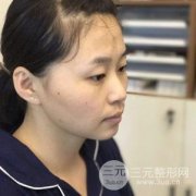 韩式定点双眼皮手术前后对照图真人果分享