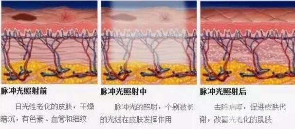 光子嫩肤