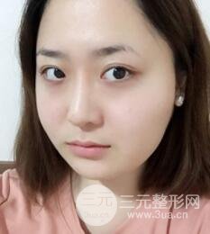 B****手术