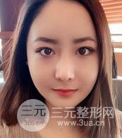 B****手术