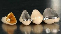 装个烤瓷牙多少钱？镍铬|钛合金|钴铬|全瓷烤瓷牙哪种好？