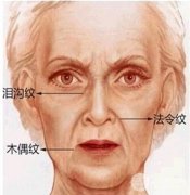 去法令纹多少钱  怎么去法令纹