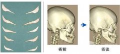 削骨截骨手术危险吗？价格是多少？有什么后遗症？