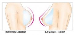 娜高假体隆胸多少钱?价格贵不贵?