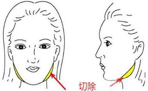 咬肌可以切除吗、咬肌切除手术多少钱