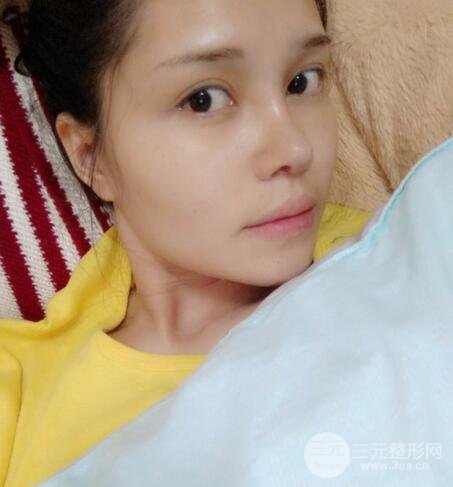 鼻头缩小术过程图，鼻头缩小恢复日记