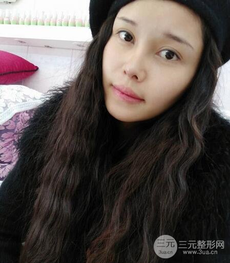 鼻头缩小术过程图，鼻头缩小恢复日记