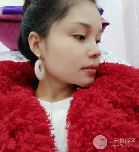 鼻头缩小术过程图，鼻头缩小恢复日记