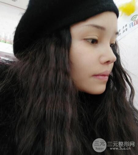 鼻头缩小术过程图，鼻头缩小恢复日记