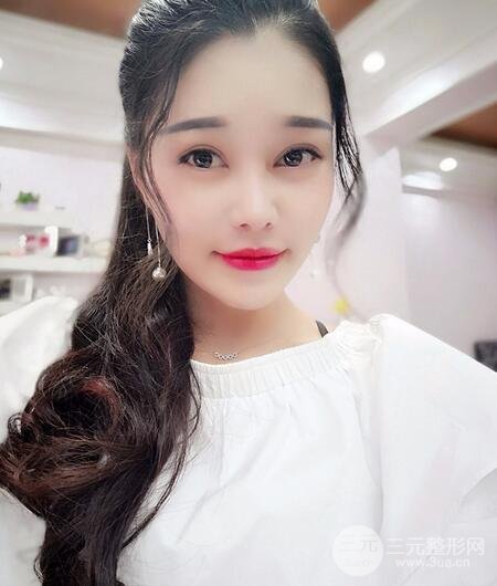 鼻头缩小术过程图，鼻头缩小恢复日记