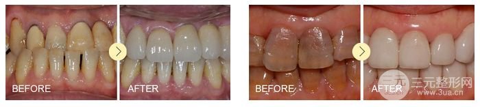 四环素牙如何变白、牙齿变白具体方法有哪些