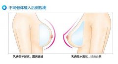 妙桃假体隆胸价格，价格是多少?
