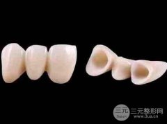 哪种材料烤瓷牙比较好 价格多少钱