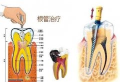 做根管缓解要多少钱