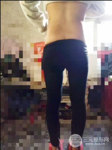 环形腰部吸脂案例