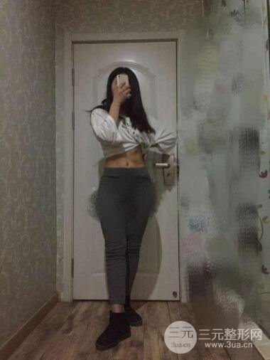 环形腰部吸脂案例