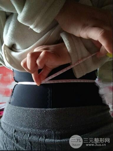 环形腰部吸脂案例