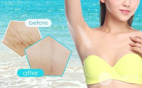 激光脱毛还会再长吗、腋窝激光脱毛多少钱