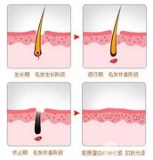 激光脱毛多长时间一次
