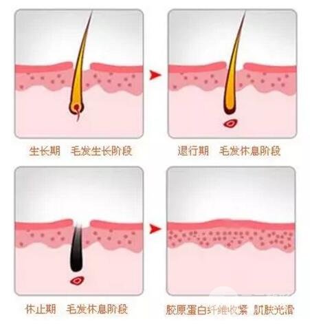 激光脱毛