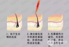 艺星整形：激光脱毛多久做一次?