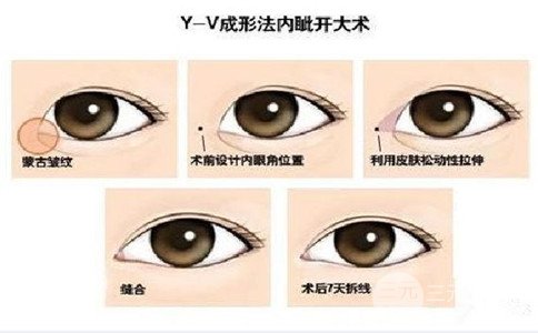 韩式微创开眼角多久恢复自然、一般需要多少钱